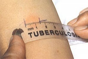 Справка о реакции Манту купить в СПб